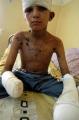 Wahid wurde von einer Streumunition verletzt. Foto: A. Carle für Handicap International 